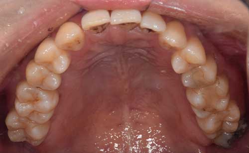 麻布十番歯科の親知らずの症例イメージ
