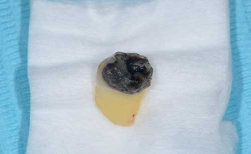 麻布十番歯科の抜歯後の虫歯になっていた親知らずのイメージ