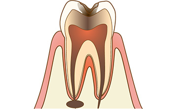 歯の根の先に膿がたまっている