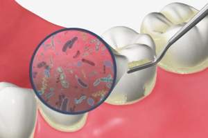 プラークがついている歯のイメージ