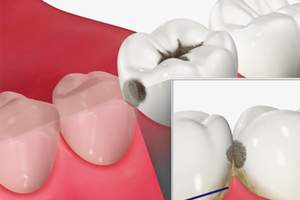 虫歯になりやすい咬合面で汚れが溜まりやすい部分のイラスト