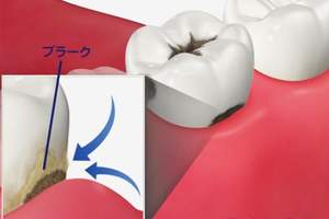 歯と歯ぐきの境目の歯頚部で汚れが溜まりやすい部分のイラスト