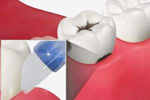 歯と歯の間の歯頚部へのタフトブラシの当て方