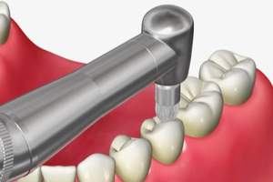 歯科医院で行うPMTCでバイオフィルムを除去している口腔内のイメージ