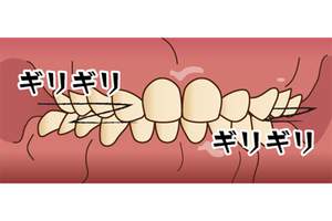 食いしばり・歯ぎしりのイラスト