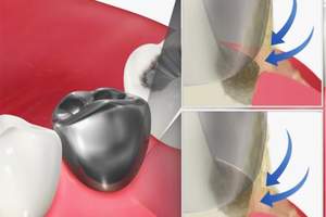 歯と被せ物の隙間に汚れが溜まっているイラスト