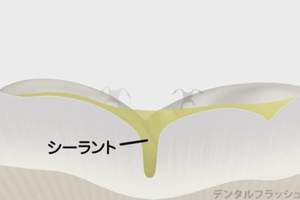 小児虫歯のシーラントのイラスト