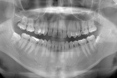 麻布十番の歯医者さんで治療前に撮影するレントゲン写真
