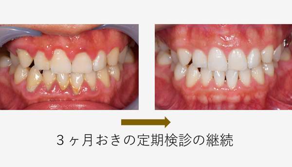 麻布十番の歯医者さんで3ヶ月おきに定期検診を受けた場合の症例写真