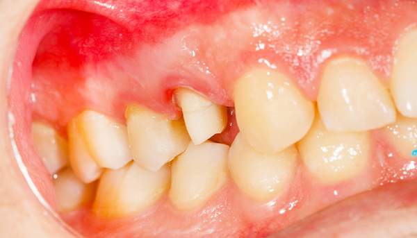 歯周病の人の口内のイメージ