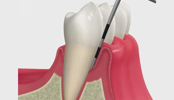 歯周病検査の一つとして歯周ポケットの深さを検査しているイラスト