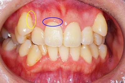 歯周病症例の治療後