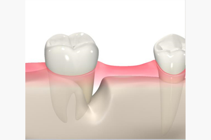 再生治療で使用する薬が患部で維持できず効果がない場合の歯と歯ぐきのイメージ