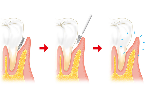 歯周病治療の歯石を取り除く工程のイラスト