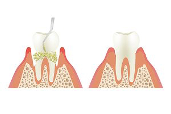 歯周ポケットの深いところの歯石を除去しているイラスト