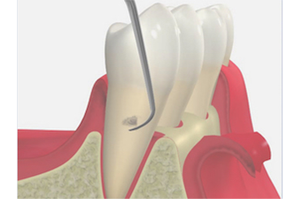歯周外科処置（フラップ手術）でプラークや歯石を除去しているイラスト