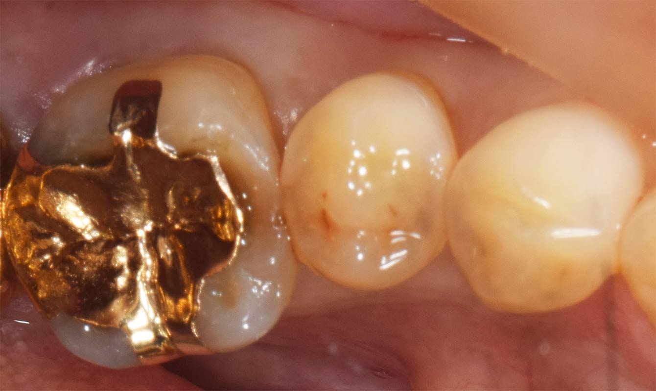 麻布十番歯科で奥歯の虫歯症例の画像
