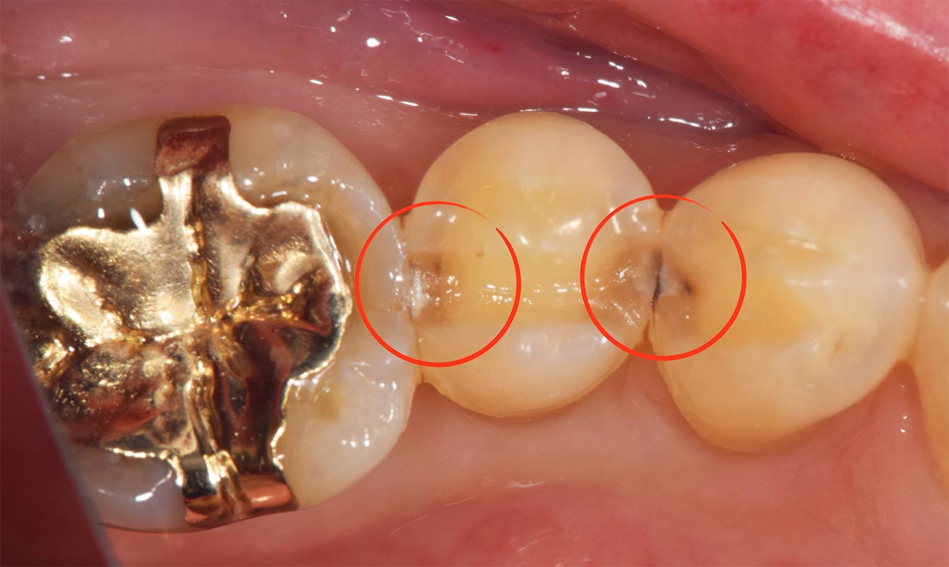 麻布十番歯科で奥歯の虫歯症例で治療前の画像