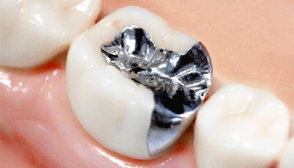 麻布十番歯科で銀歯を詰めた歯のイメージ写真