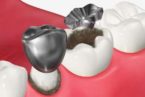 銀歯などの詰め物と歯の隙間から虫歯になっているイメージ