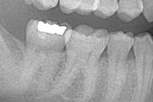 銀歯を詰めた口内のレントゲン写真