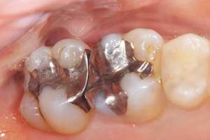 麻布十番歯科で銀歯の症例の口腔内写真