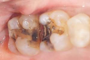 麻布十番歯科で銀歯の中が虫歯になっている症例の口腔内写真