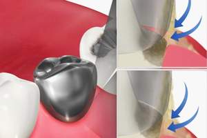 歯と被せ物の隙間に汚れが溜まっているイラスト