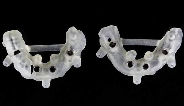 麻布十番歯科でインプラント埋入位置を正確にするためのサージカルガイド用のマウスピース