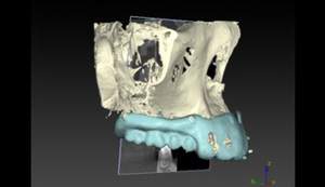 麻布十番歯科のサージカルガイド制作の3Dガイド作成イメージ