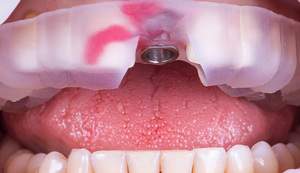 麻布十番歯科の完成したサージカルガイドの手術時の使用イメージ