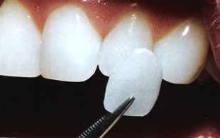 ラミネートベニア