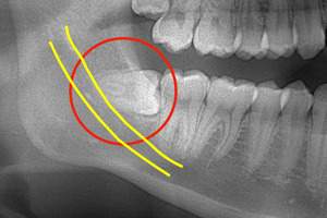 麻布十番歯科で抜歯予定の親知らずの生え方を確認するためのレントゲン写真