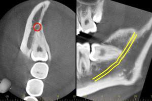麻布十番歯科でのCT画像。親知らずの生え方を確認し2回に分けて抜歯を行う方法を選択
