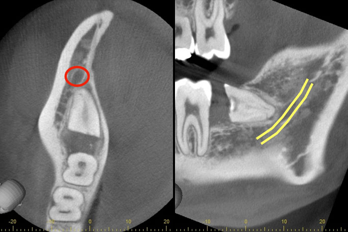 麻布十番歯科の親知らずの1回目の治療から3ヶ月経過した状態を確認するためのCT画像