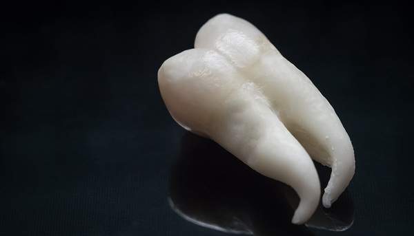 抜歯後の根が曲がった親知らずの写真。麻布十番歯科では親知らずの生え方等を確認できるようCTを完備しています