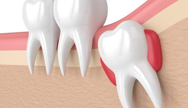 親知らずが歯ぐきに埋まっており抜歯が難しい場合のイメージ