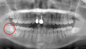 麻布十番歯科での右下の親知らずが真横に生えている症例のレントゲン写真