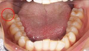 麻布十番歯科での右下の親知らずが真横に生えている症例の口腔内写真