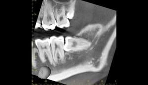 麻布十番歯科での右下の親知らずが真横に生えている症例のCT画像②