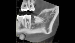 麻布十番歯科での1回目の親知らず抜歯から3ヶ月後のCT画像②