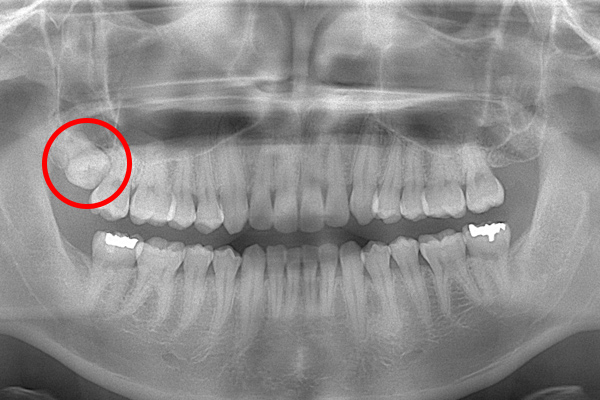 麻布十番歯科の上顎半埋伏の親知らず症例のレントゲン写真