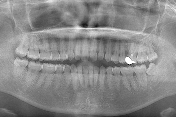 麻布順番歯科の斜めに生えている親知らず症例のレントゲン写真