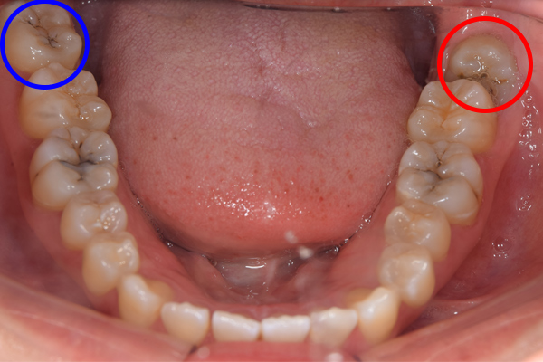 麻布順番歯科の斜めに生えている親知らず症例の口腔内の写真