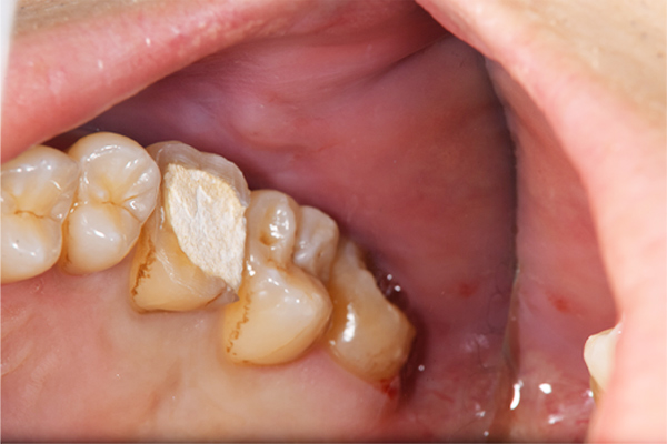 麻布十番歯科で上顎の斜めに生えている親知らずの抜歯前の口腔内写真