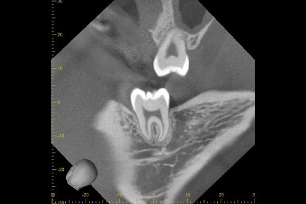 麻布十番歯科の上顎親知らずのCT画像