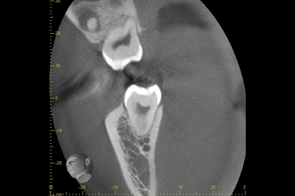 麻布十番歯科の下顎親知らずのCT画像