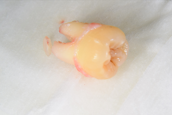 麻布十番歯科の下顎親知らずの抜去歯