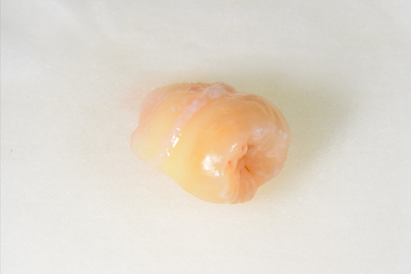 麻布十番歯科の上顎親知らずの抜去歯