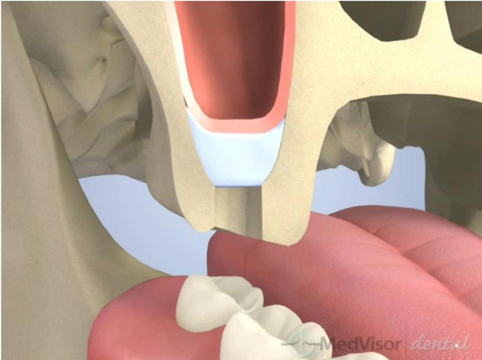 麻布十番の歯医者のインプラント治療で使用するサイナスリフト・ソケットリフト